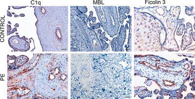 Distinct Roles of Classical and Lectin Pathways of Complement in Preeclamptic Placentae